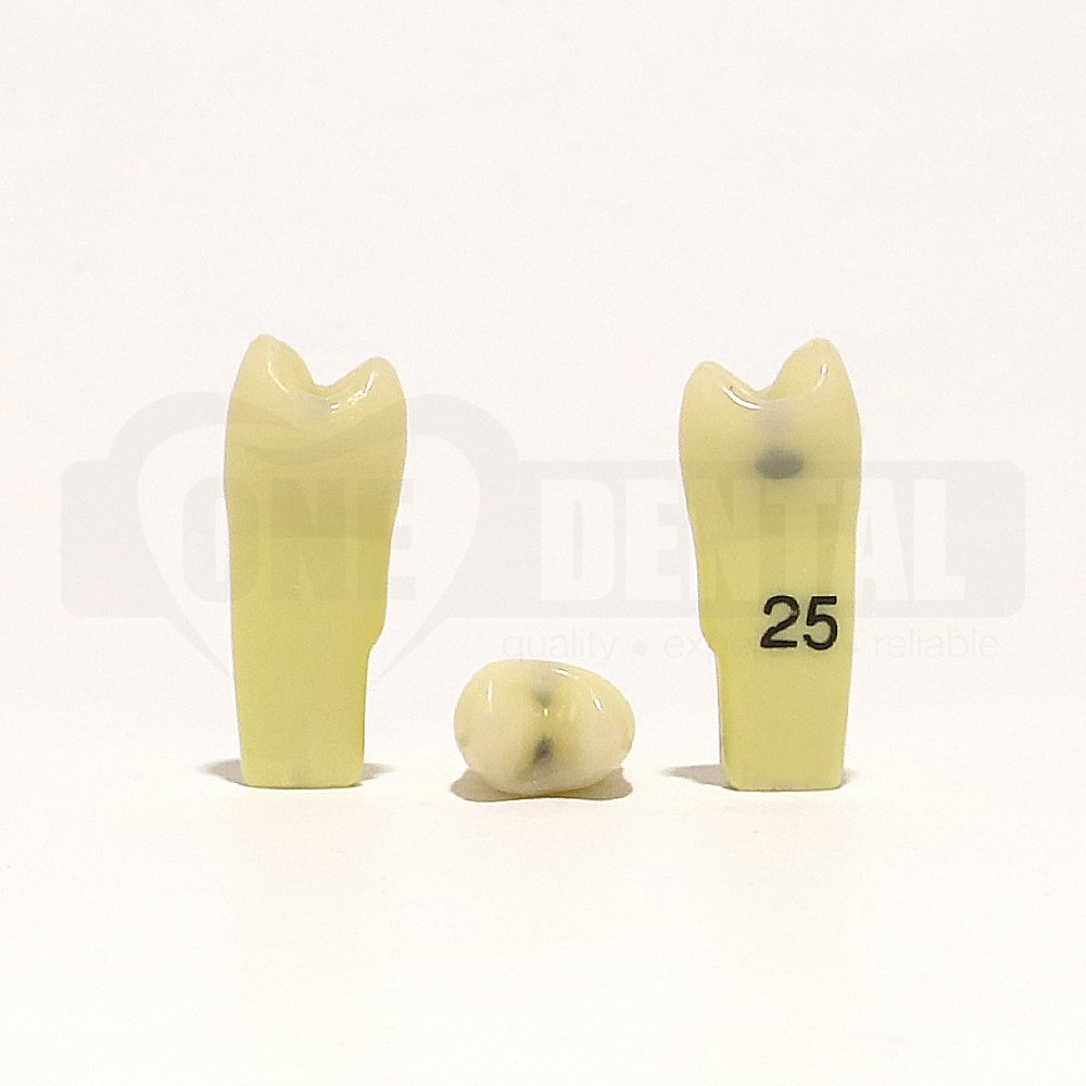 Caries Tooth 25 Occ + D GW Extended Adult Scope for 2010 Adult Model
